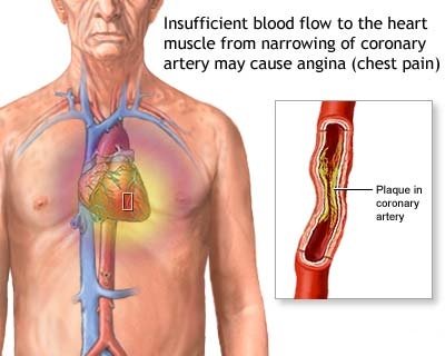 Angina Symptoms